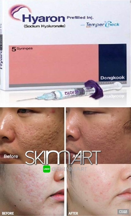 Hyaron 1หลอด – SKINMART