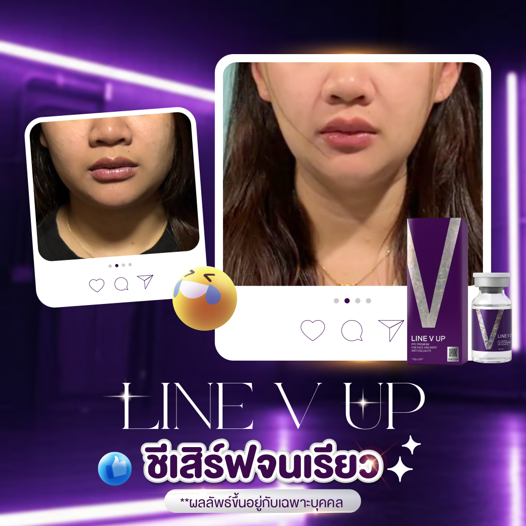 LINE V UP - Image 9